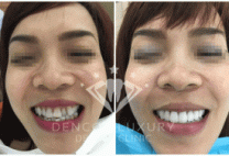 Hình ảnh phục hình trước – sau bọc răng sứ thẩm mỹ tại Nha khoa Dencos Luxury