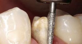 Bọc răng sứ mất bao lâu – Thời gian & chi tiết các bước thực hiện