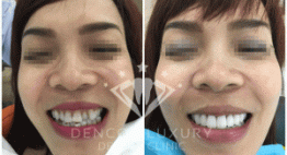 Hình ảnh phục hình trước – sau bọc răng sứ thẩm mỹ tại Nha khoa Dencos Luxury