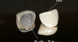 Tổng hợp từ A-Z kiến thức về răng sứ titan cho bạn tìm hiểu