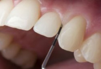 Mài răng có nguy hiểm không – Lý giải từ chuyên gia