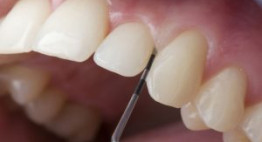 Mài răng có nguy hiểm không – Lý giải từ chuyên gia