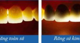 Nhược điểm răng sứ kim loại – Những vấn đề bạn nên nắm rõ