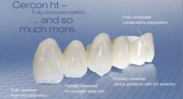 Răng sứ Cercon – Cấu tạo, ưu điểm và giá thành sử dụng