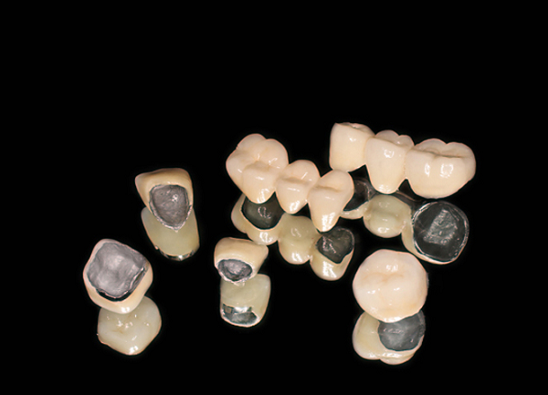 Bọc răng sứ titan giá bao nhiêu tiền & có độ bền tối đa bao lâu? 1