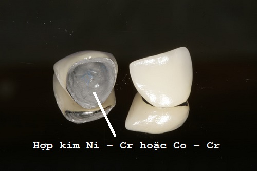 Nhược điểm răng sứ kim loại 