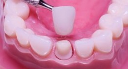 Bọc răng thẩm mỹ là gì – Tất cả những gì bạn cần biết là đây!