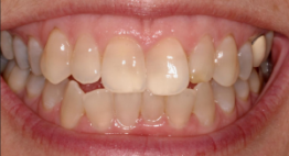 Có nên bọc răng sứ không dưới góc nhìn của bác sĩ nha khoa