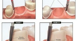 Mài răng – Tổng hợp kiến thức CHUẨN XÁC cho bạn tìm hiểu