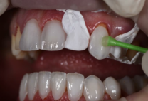 Veneer sứ giá bao nhiêu? – Chi phí tại nha khoa uy tín