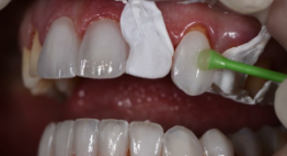 Veneer sứ giá bao nhiêu? – Chi phí tại nha khoa uy tín