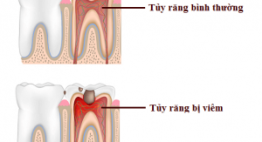 Tổng hợp từ A-Z các kiến thức về bệnh viêm tủy răng