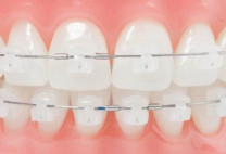 Niềng răng mắc cài sứ và những điều cần tìm hiểu.