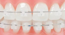 Niềng răng mắc cài sứ và những điều cần tìm hiểu.